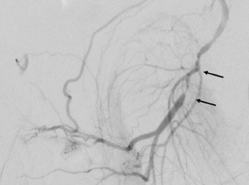 pénisz stent