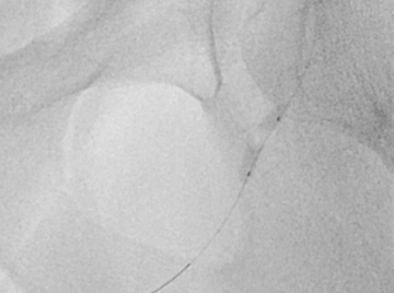 Abbildung Ballondilation der Arterie