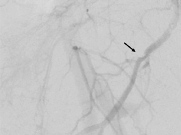 Abbildung Residuelle Stenose